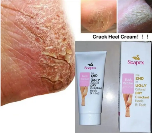 Foot creams for cracked heels soapex